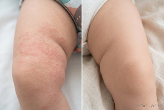 Polyester and Baby Rashes: What the Data Actually Says About Synthetic Bedding
